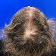 Hair transplant for women