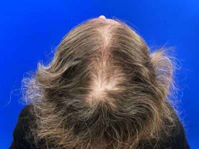 Hair transplant for women