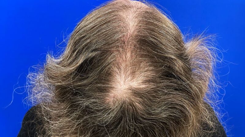 Hair transplant for women